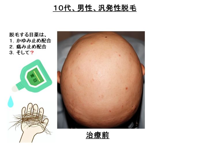 円形脱毛症　病院